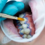 Laser Teeth Whitening in Turkey