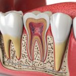 Root Canal Treatment in Turkey