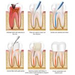 Steps of Root Canal Treatment in Turkey