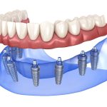 All on 8 Dental Implants Process in Turkey