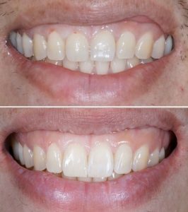 Composite Bonding in Turkey before after