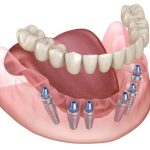 3 on 6 Dental Implants