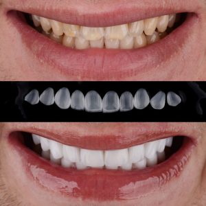 What is a full set of dental veneers_