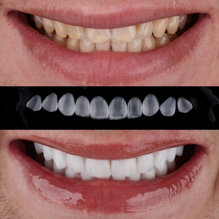 How much is a full set of veneers cost Turkey?