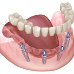 All-on-4 Dental Implants