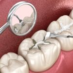 Dental Fillings in Turkey