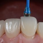 E-max Coatings in Turkey