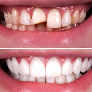 Zirconium Crowns in Turkey before after