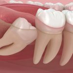 What type of wisdom teeth surgery Turkey is more complex_