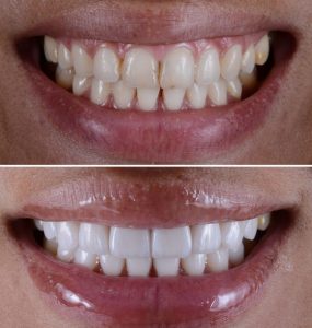 Dentures in Turkey Before and After