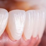 Laminate Veneers in Turkey