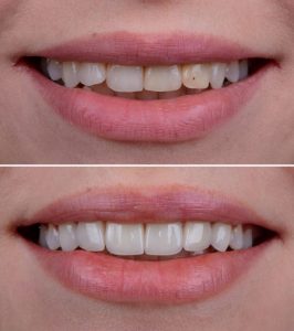 What are laminate veneers_