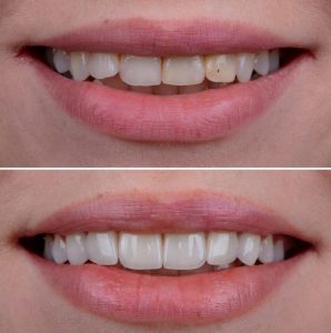 What are laminate veneers_