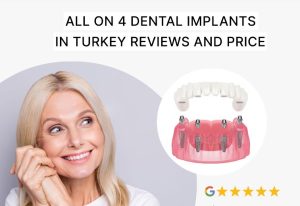 All on 4 Dental Implants in Turkey Reviews and Price