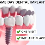 Same Day Dental Implants in Turkey