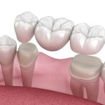 Dental Bridge Turkey