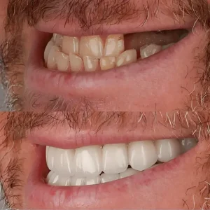 Full Mouth Dental Implants