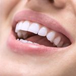 How To Find The Best Place to Get Veneers in Turkey?