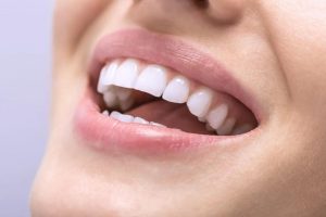 How To Find The Best Place to Get Veneers in Turkey?