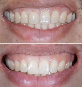 Dental Bridges in Turkey Before and After