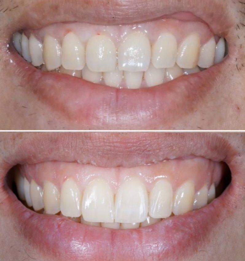 Dental Bridges in Turkey Before and After
