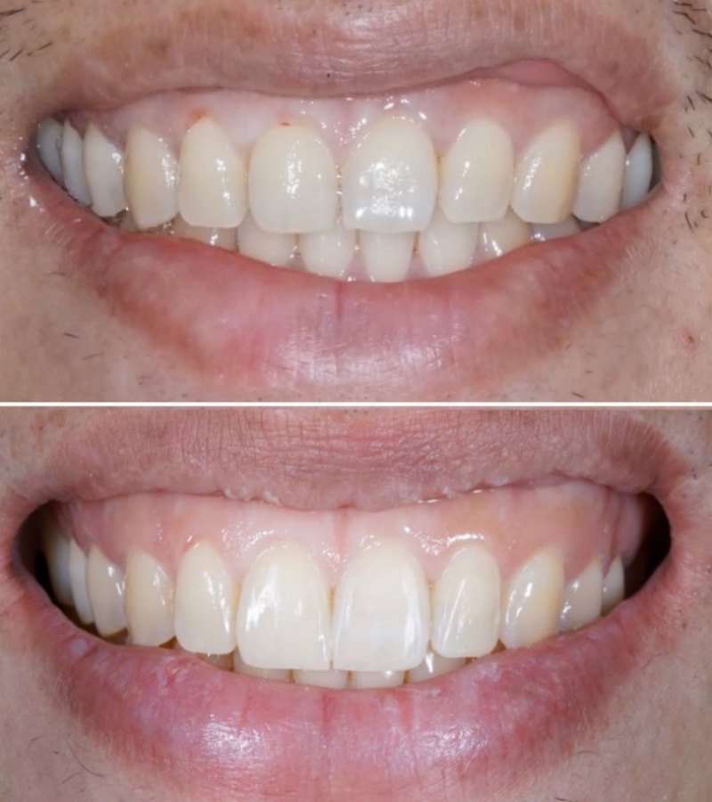 Dental Bridges in Turkey Before and After