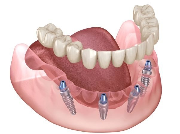 3D image showing all-on-4-dental-implants treatment in Turkey