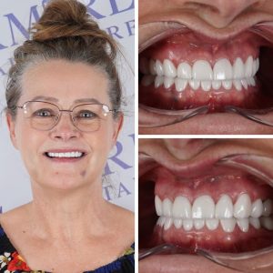 Dental implants before and after