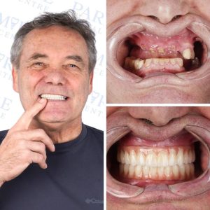 dental implants before-after
