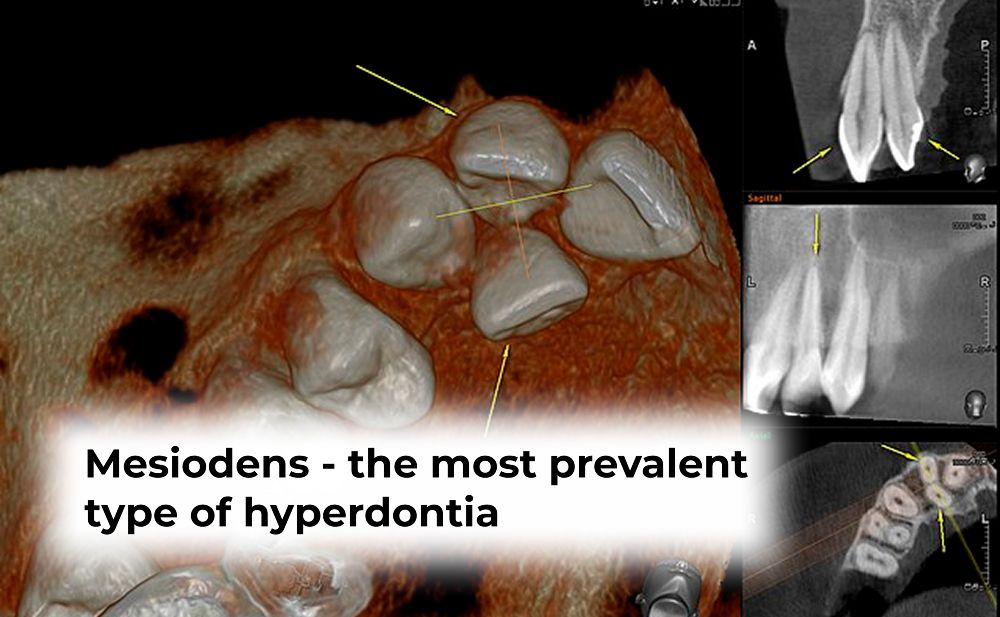 Freddie Mercury Extra Teeth