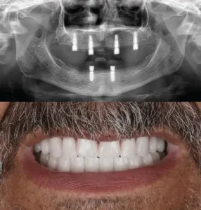 full-mouth-dental-implants-before-after-photo