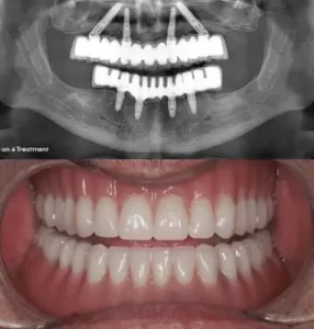 full-mouth-dental-implants-before-after-xray
