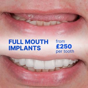 full mouth dental implants
