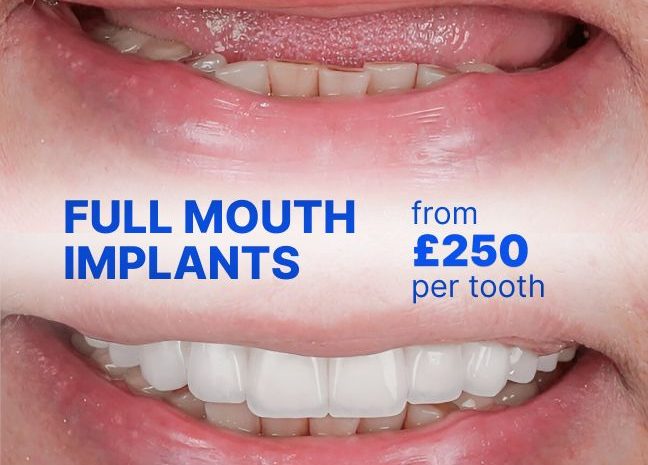 full mouth dental implants