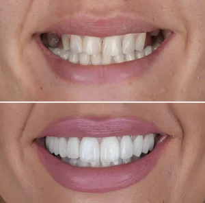 All on 4 Dental Implants