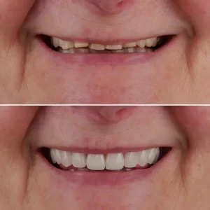 All on 4 Dental Implants