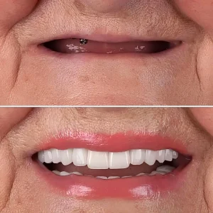 All on 4 Dental Implants
