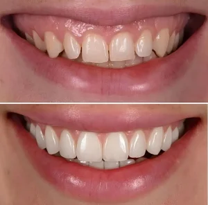All on 4 Dental Implants