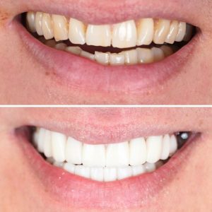 Zirconium crowns