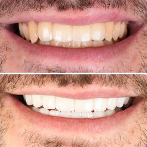Zirconium crowns