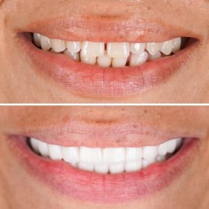 Zirconium crowns