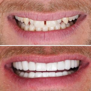 Zirconium crowns